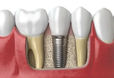 Implantes Dentales