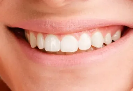 Blanqueamiento Dental
