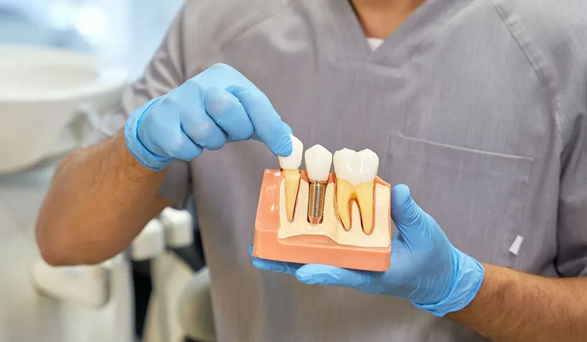 Implantes Dentales