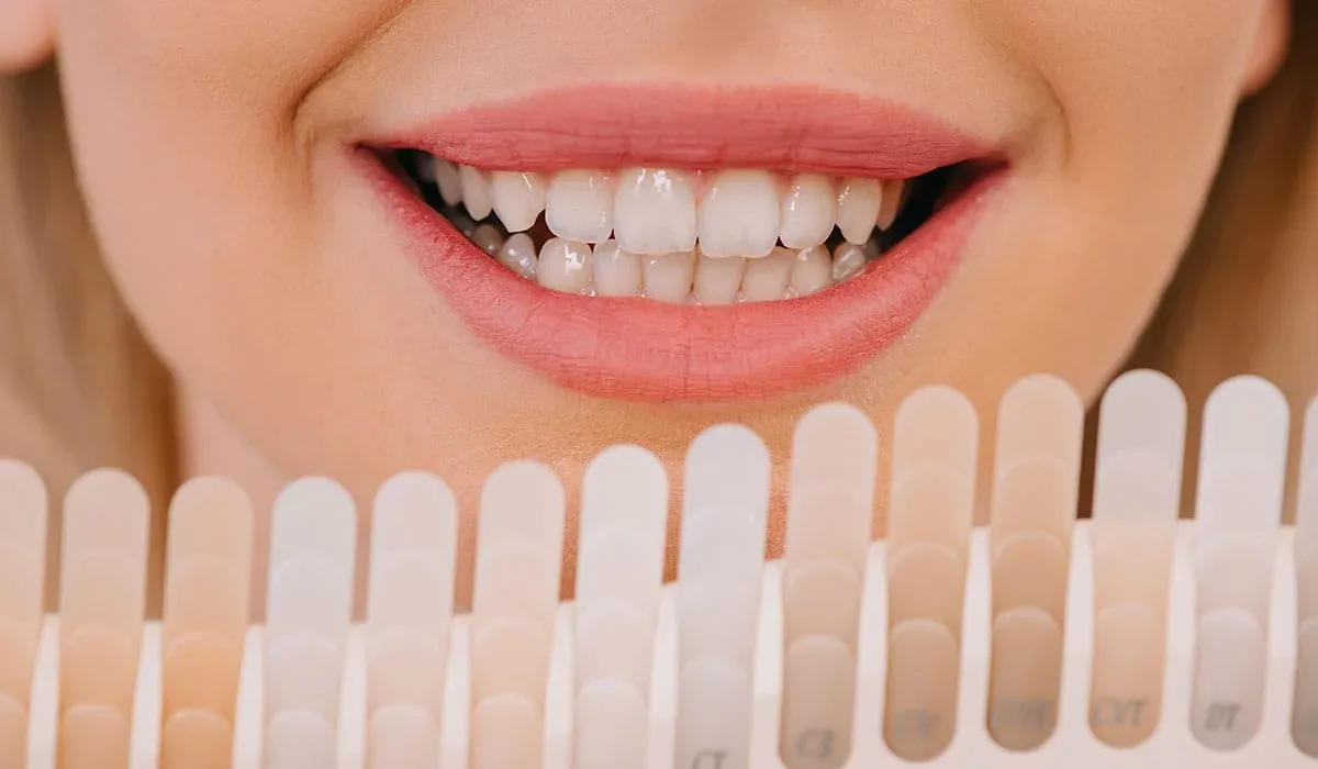 Blanqueamiento Dental