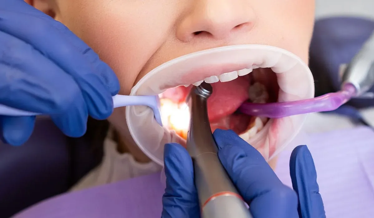 Tratamiento de Caries