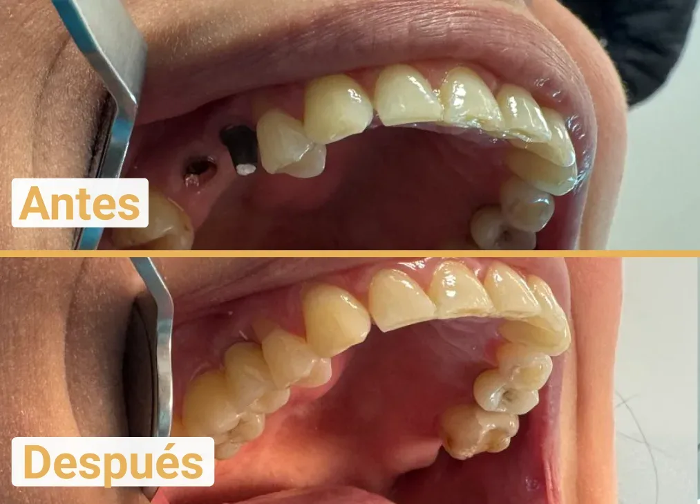 Implantes Dentales