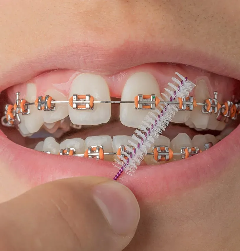 ¿Qué cuidados requieren los Brackets?