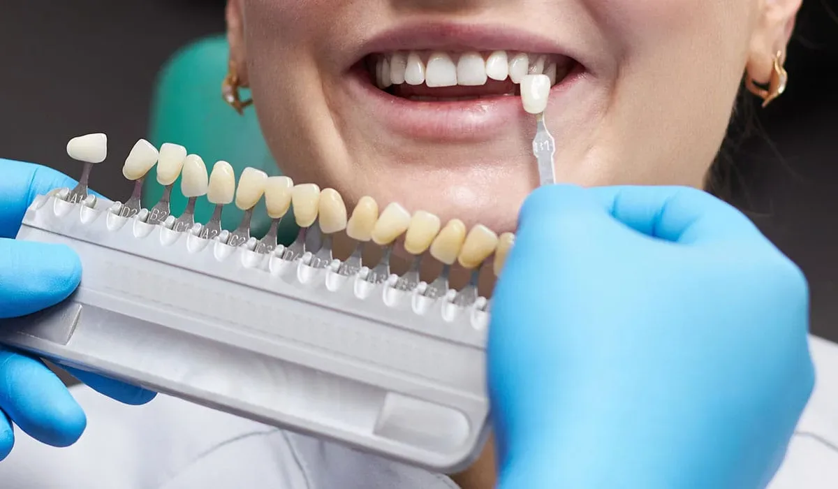 ¿Cuánto tiempo duran las carillas dentales?