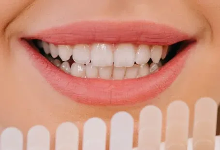 ¿Cuánto dura el efecto del blanqueamiento dental?