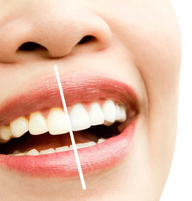 ¿El blanqueamiento dental es seguro?